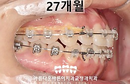 수술후