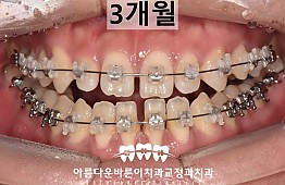 수술후