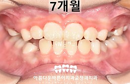 수술후