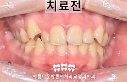 수술전