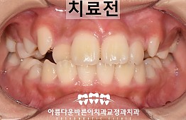 수술전