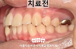 수술전