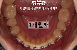 수술후