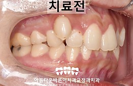수술전