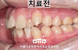 수술전