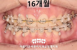 수술후