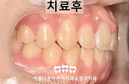 수술후