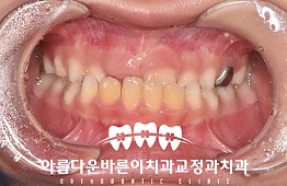 수술전