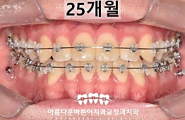 수술후