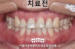 수술전