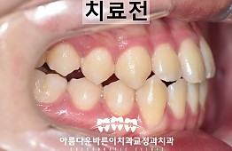 수술전