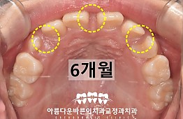 수술후