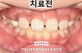 수술전