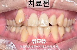 수술전