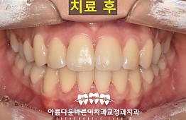 수술후