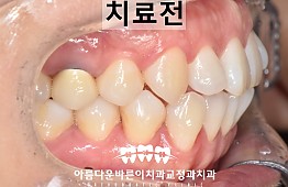 수술전