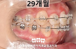 수술후