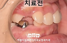 수술전