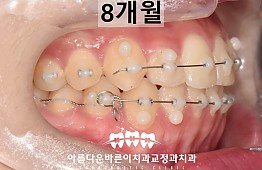 수술후