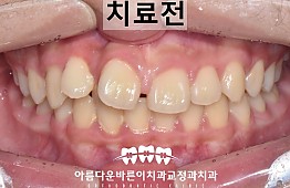 수술전