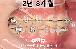 수술후