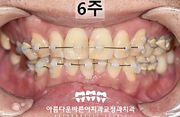 수술후