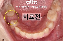 수술전