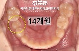 수술후