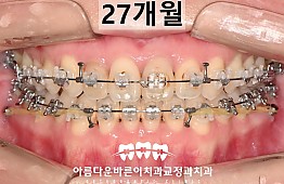 수술후