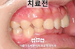 수술전