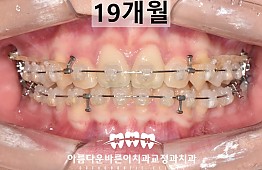 수술후