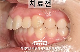 수술전