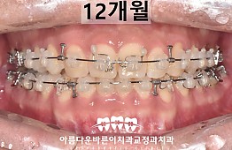 수술후