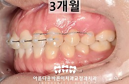 수술후