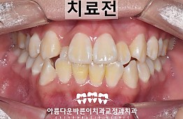 수술전