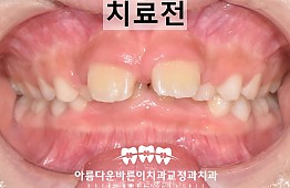 수술전