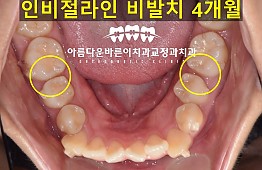 수술후