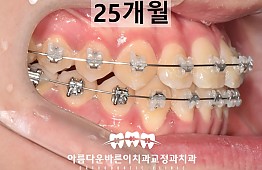 수술후