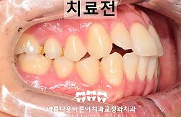 수술전