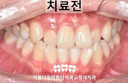 수술전