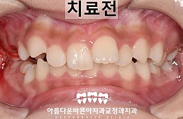 수술전