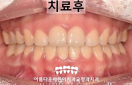 수술후