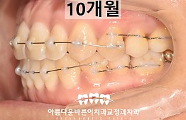 수술후