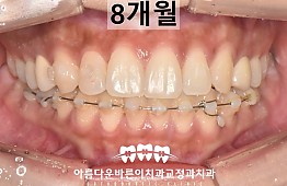 수술후