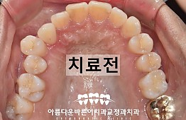 수술전