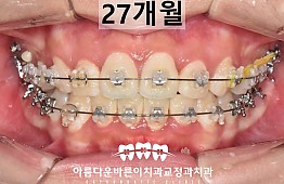 수술후