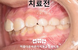 수술전