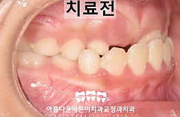 수술전