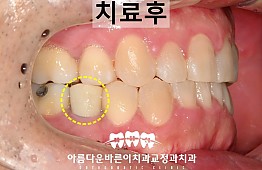 수술후