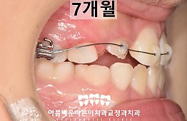 수술후